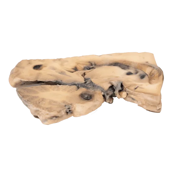 Erler-Zimmer MP2001 Baziliarinės Arterijos Berry Aneurizmos 3D Modelis