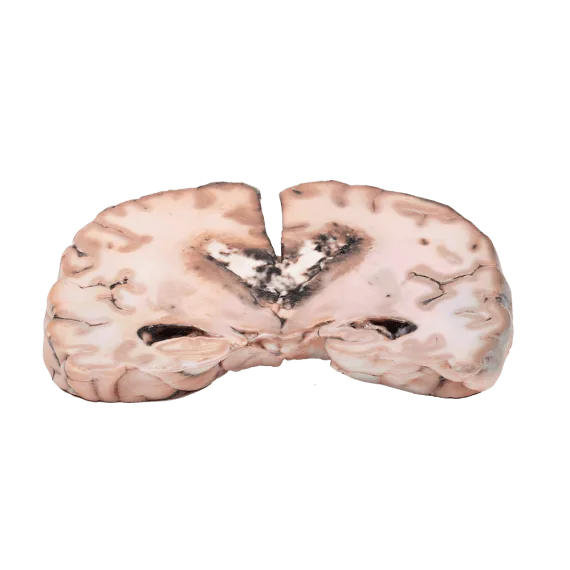 Erler-Zimmer MP2003 3-4 Laipsnio Glioma 3D Modelis