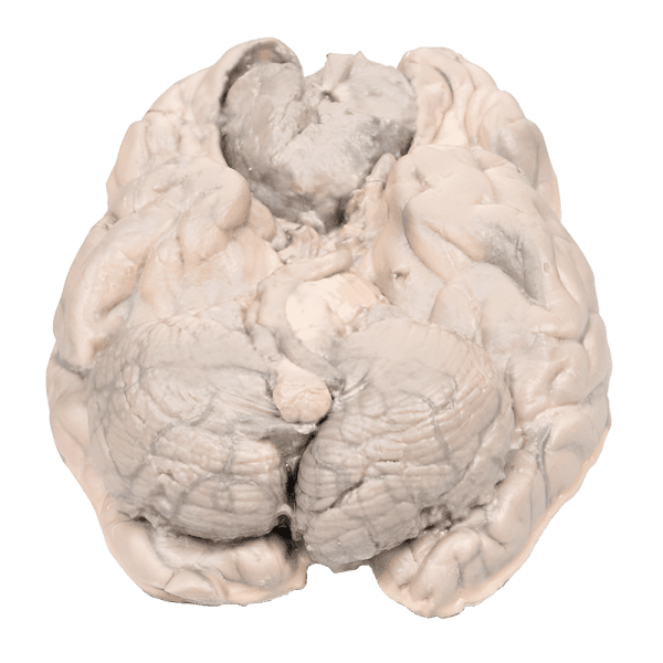 Erler-Zimmer MP2004 Meningiomos 3D Modelis