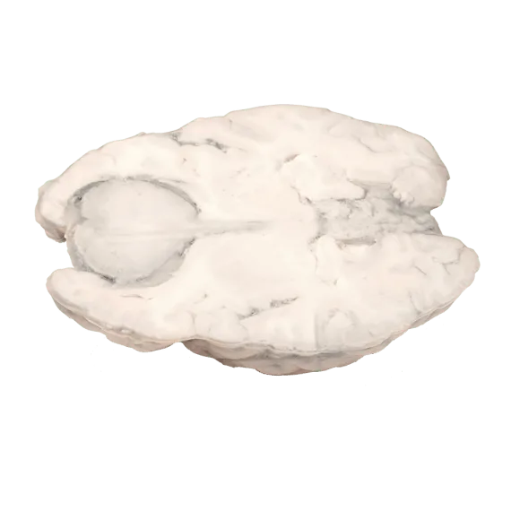 Erler-Zimmer MP2004 Meningiomos 3D Modelis