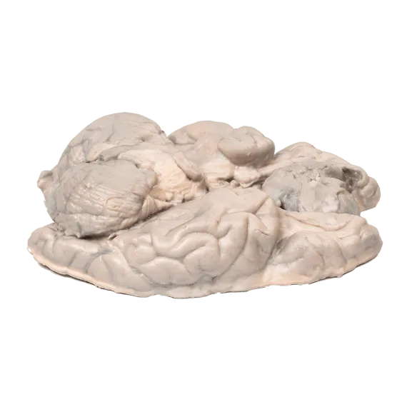 Erler-Zimmer MP2004 Meningiomos 3D Modelis