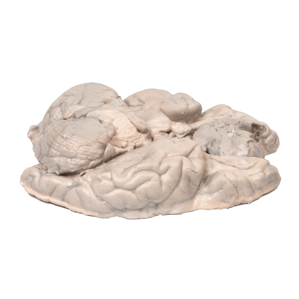 Erler-Zimmer MP2004 Meningiomos 3D Modelis