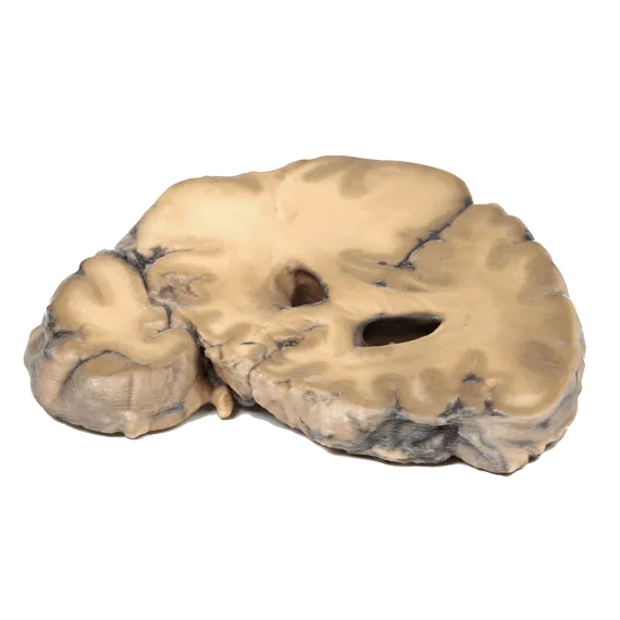 Erler-Zimmer MP2007 Metastazavusios Adenokarcinomos 3D Modelis