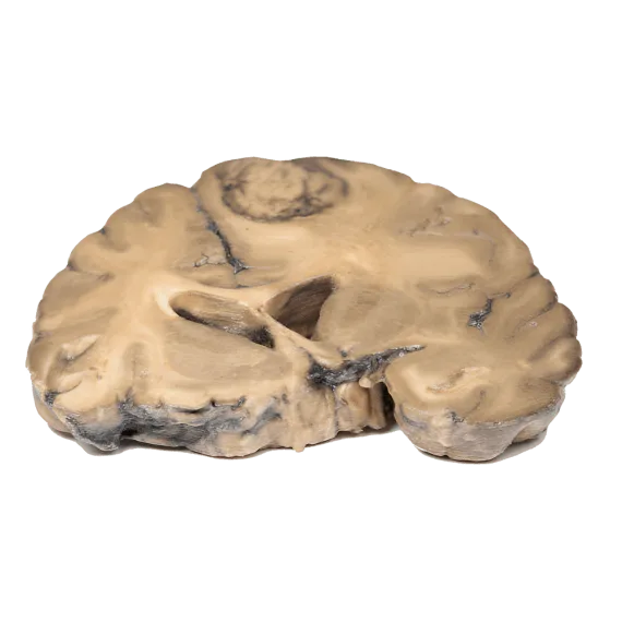 Erler-Zimmer MP2007 Metastazavusios Adenokarcinomos 3D Modelis