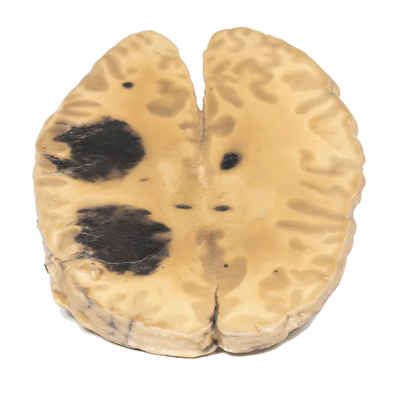 Erler-Zimmer MP2009 Ūminės Mieloidinės Leukemijos 3D Modelis