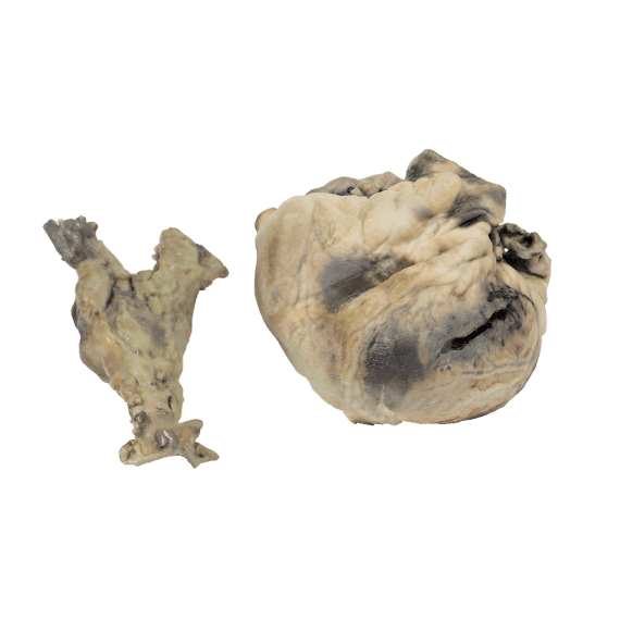 Erler-Zimmer MP2035 Hidatidinės Ligos 3D Modelis