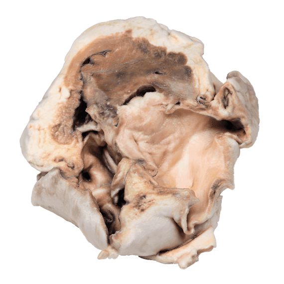 Erler-Zimmer MP2038 Dviburio Aortos Vožtuvo Stenozės 3D Modelis