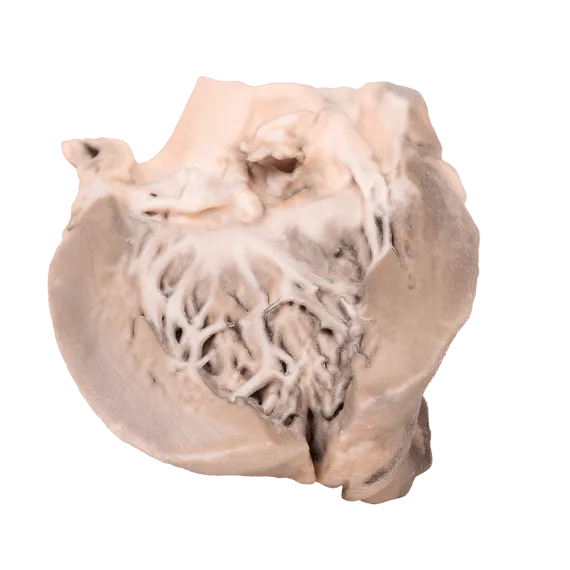 Erler-Zimmer MP2041 Ūminio Bakterinio Endokardito 3D Modelis
