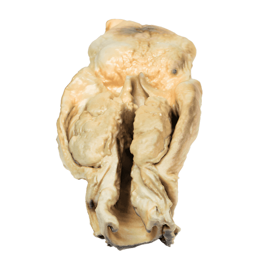 Erler-Zimmer MP2050 Gerklų Karcinomos 3D Modelis