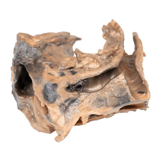 Erler-Zimmer MP2053 Įkvėptas Svetimkūnis Trachėjoje 3D Modelis