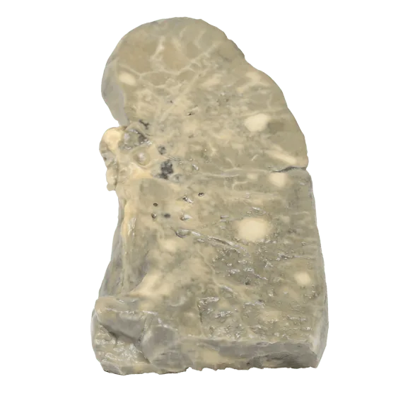 Erler-Zimmer MP2056 Metastazavusios Karcinomos 3D Modelis