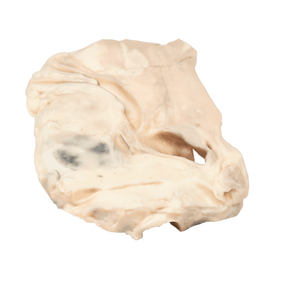 Hodžkino Limfomos 3D Modelis Erler-Zimmer MP2062