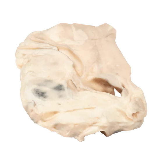 Hodžkino Limfomos 3D Modelis Erler-Zimmer MP2062