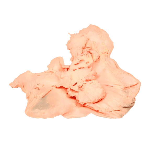 Erler-Zimmer MP2080 Skrandžio Adenokarcinomos 3D Modelis