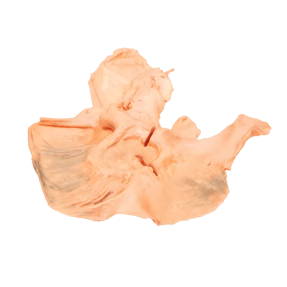 Erler-Zimmer MP2080 Skrandžio Adenokarcinomos 3D Modelis