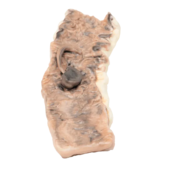 Erler-Zimmer MP2081 Pedunkuliuotos Storosios Žarnos Adenomos 3D Modelis