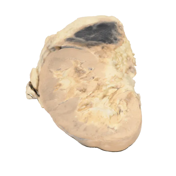 Erler-Zimmer MP2090 Antinksčių Kraujavimo 3D Modelis