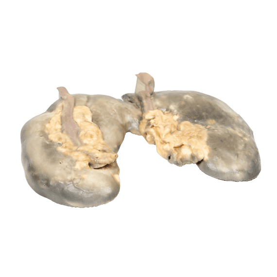 Erler-Zimmer MP2092 Susiliejusių Inkstų 3D Modelis