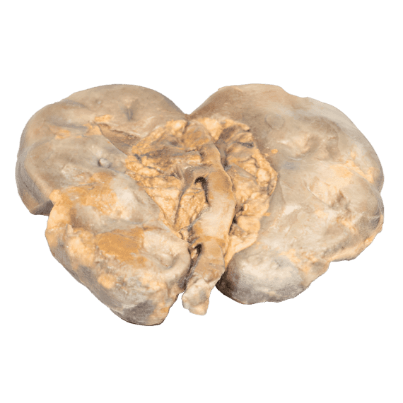 Erler-Zimmer MP2094 Inkstų Hidronefrozės Hidroureterio